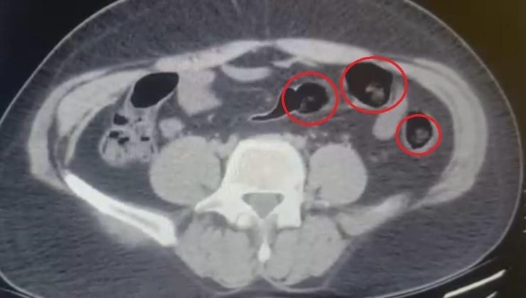 Yolcu otobüsünde şoke eden operasyon! Mide ve bağırsaklarından yarım kilo uyuşturucu çıktı