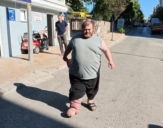 4 yıldır fil hastalığıyla mücadele ediyor! Yürümek için 82 kilo vermesi gerekiyor